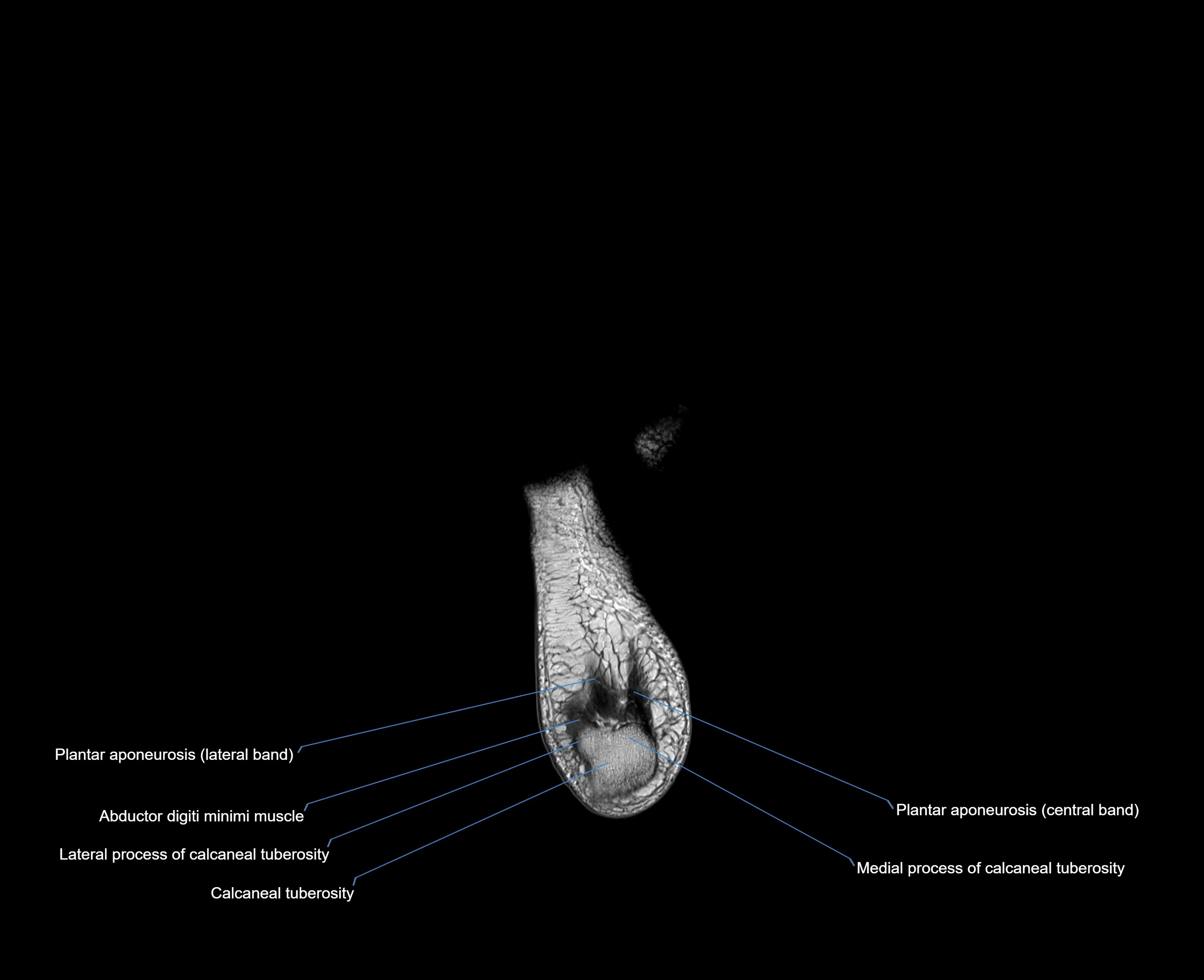 MRI foot coronal cross sectional anatomy 3T  radiology  image-img-00001-00032.webp
